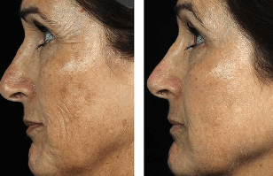 Trước và sau khi trẻ hóa da mặt