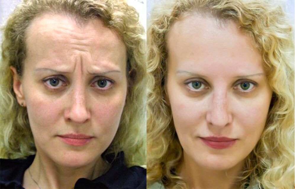 trước và sau khi sử dụng máy mát xa để trẻ hóa ltza ảnh 1