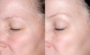 trẻ hóa vùng da quanh mắt trước và sau khi chụp ảnh