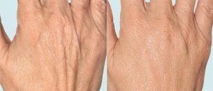 Da tay trước và sau khi điều trị bằng phân đoạn