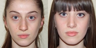 trước và sau khi trẻ hóa da bằng huyết tương